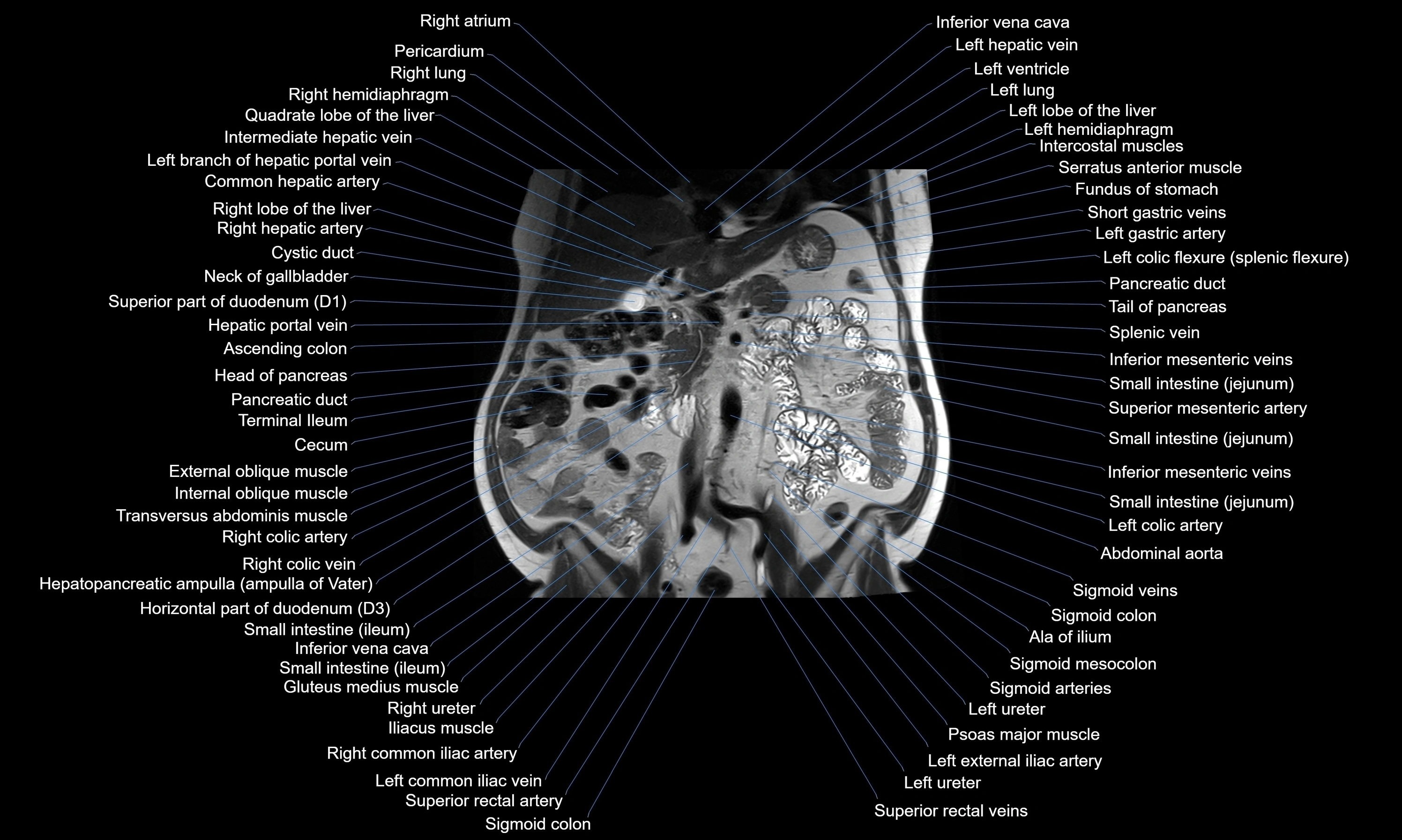 MRI Abdomen axial cross sectional anatomy radiology  image-img-00001-00028.webp